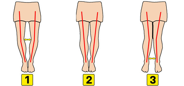 Op deze afbeelding zijn drie verschillende benen te zien. dit zijn O benen, X benen en rechte benen